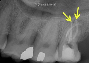 X-ray of root canal- Sachar Dental NYC