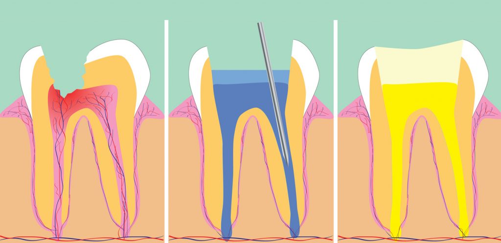 Diagram of Root Canal