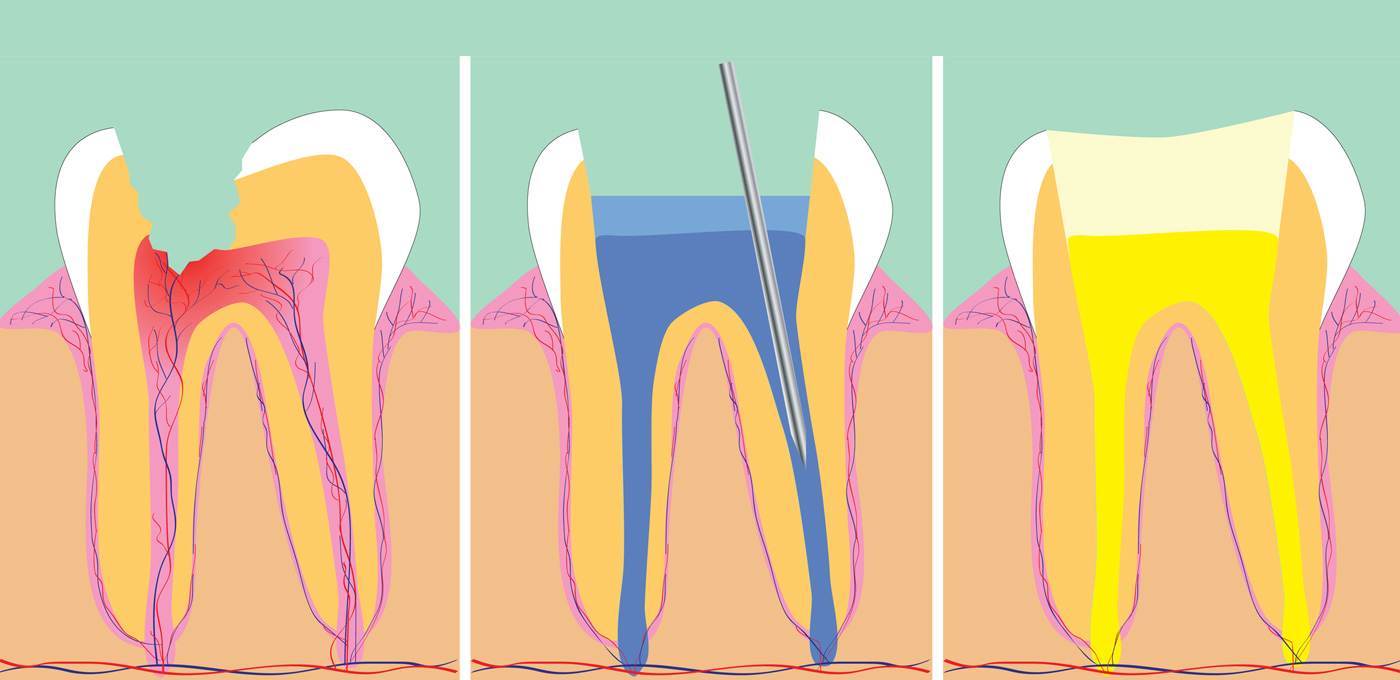 Diagram of Root Canal