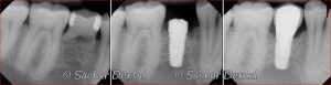 X-ray of dental implants done at Sachar Dental NYC