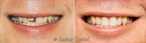 Before & After picture of a porcelain crown done at Sachar Dental NYC