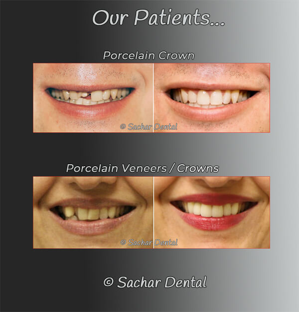 Cosmetic Dentist NYC for porcelain Crown