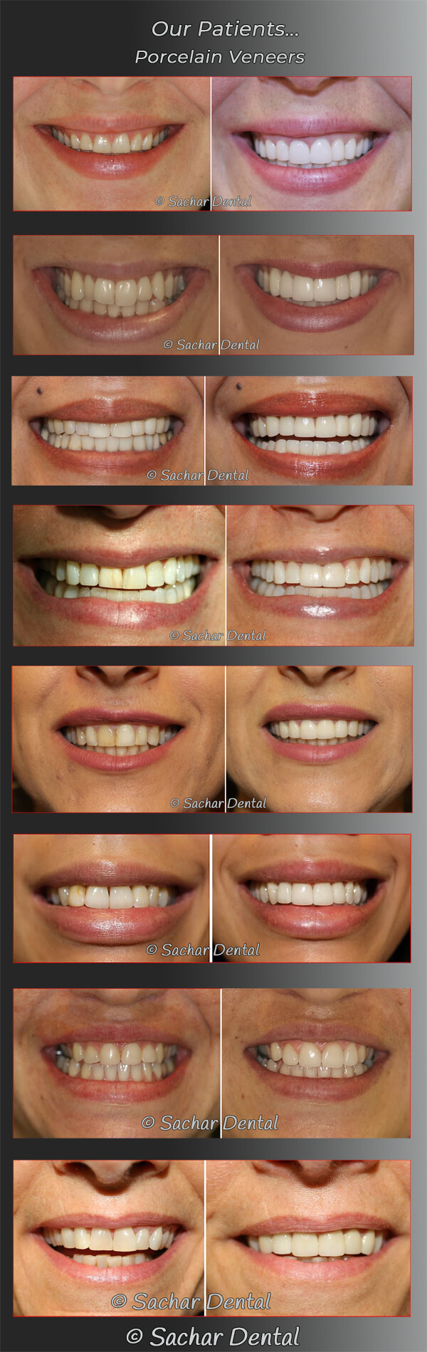 Cosmetic Dentist NYC for Porcelain Veneers