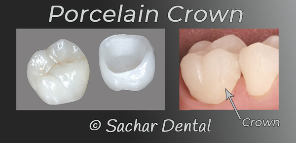 Cosmetic Dentist NYC porcelain crown diagram