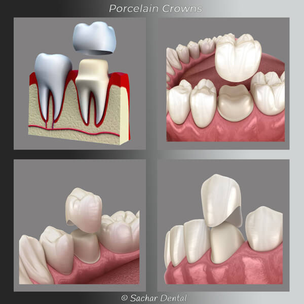 Cosmetic Dentist NYC - Porcelain crown diagram