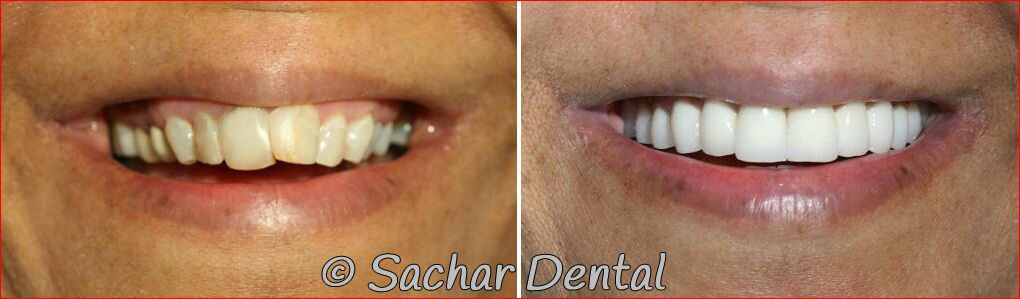 NYC Cosmetic Dentistry Pic of Before and after pictures of full mouth reconstruction with porcelain veneers and crowns ridges root canals in NYC