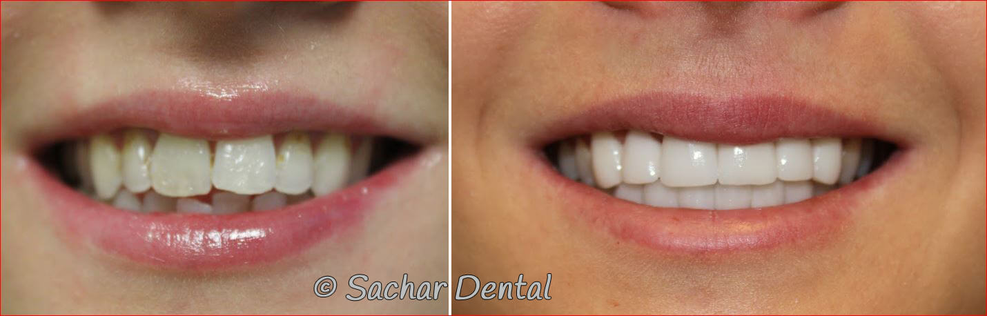 Before and after pictures of porcelain veneers