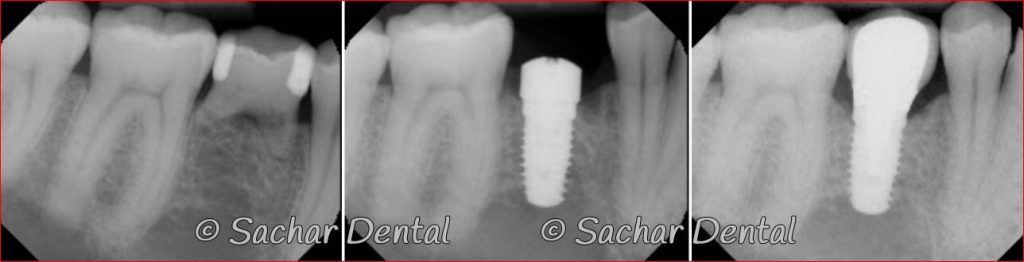 Dental Implant Specialist NYC