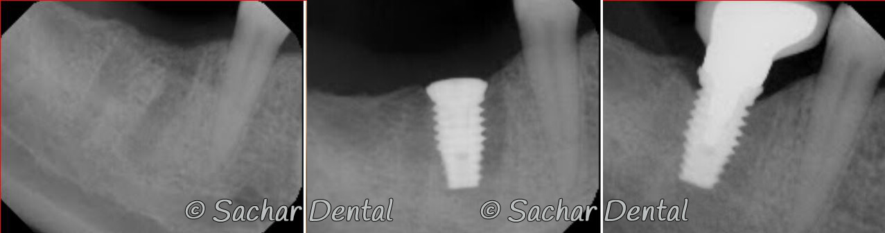 Before and after x-rays of tooth extraction and dental implant