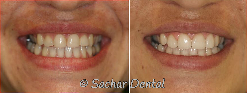 Before and after pictures of Cosmetic Dentist NYC