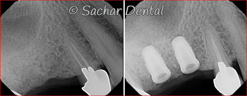 icture of Before and after x-rays of dental implants