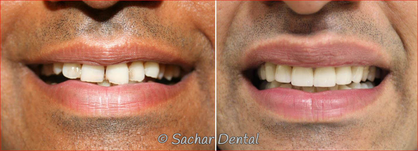 Cosmetic Dentistry NYC for crowns and veneers