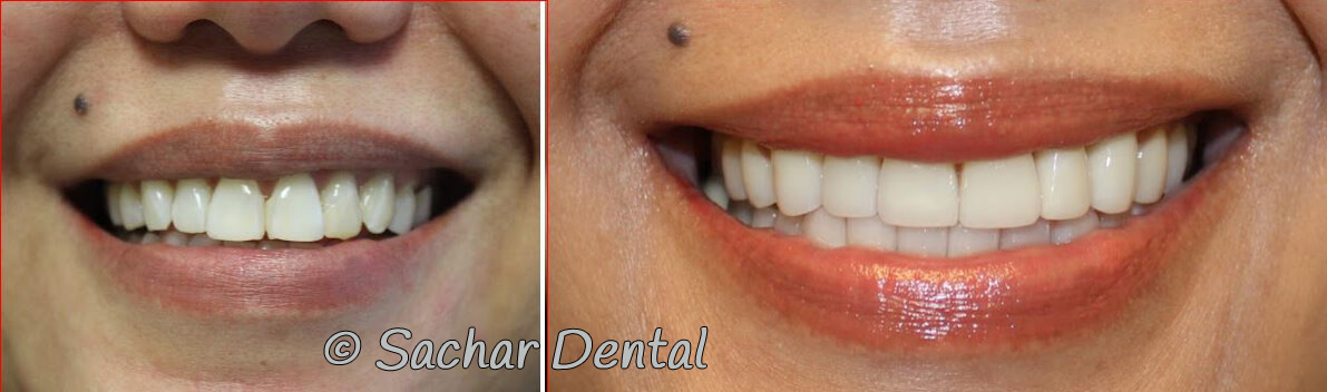 Top Cosmetic Dentist New York City - Sachar Dental NYC