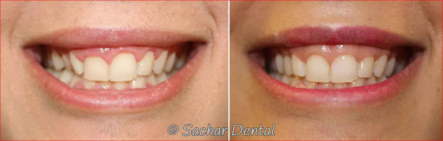 NYC cosmetic dentist doing gum lifts. Before and after pictures of cosmetic gum lifts and porcelain veneers