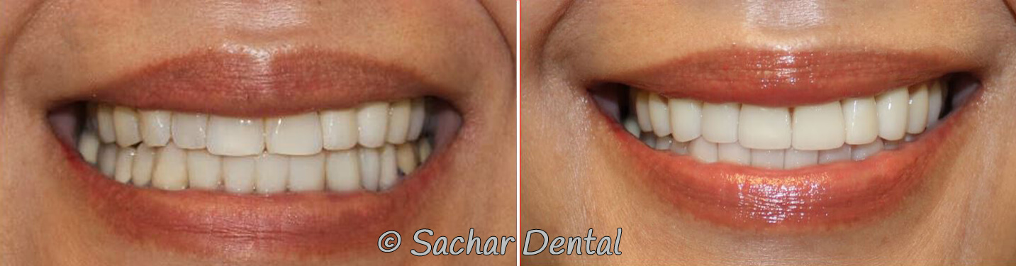 Before and after pictures of porcelain veneers and a bridge