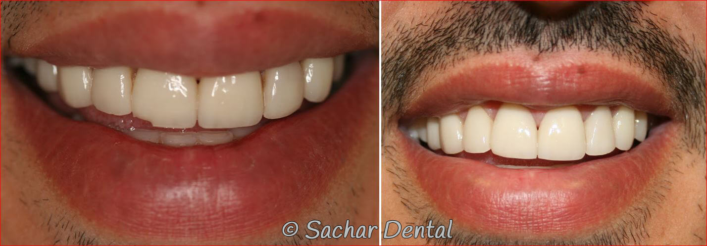 Best cosmetic dentist NYC. Before and after pictures of chipped porcelain veneer