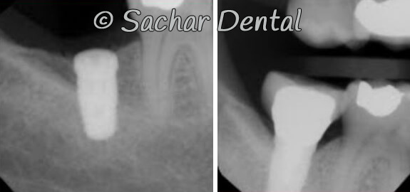 Picture of Before and after x-rays of dental implants at Sachar Dental NYC