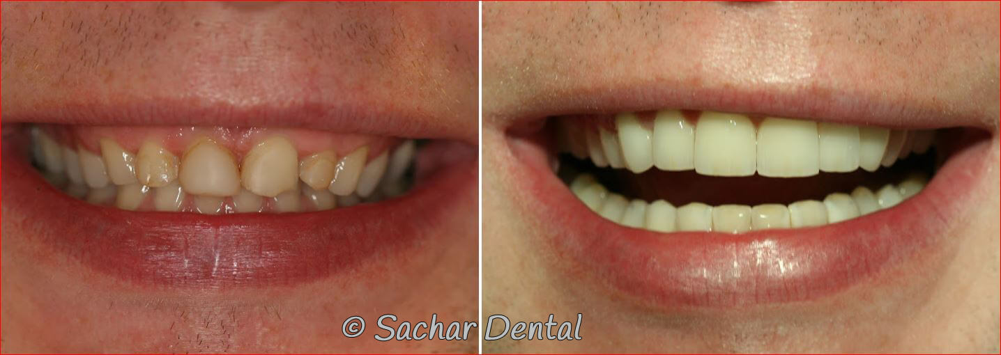 Top NYC Cosmetic Dentists can be found at Sachar Dental