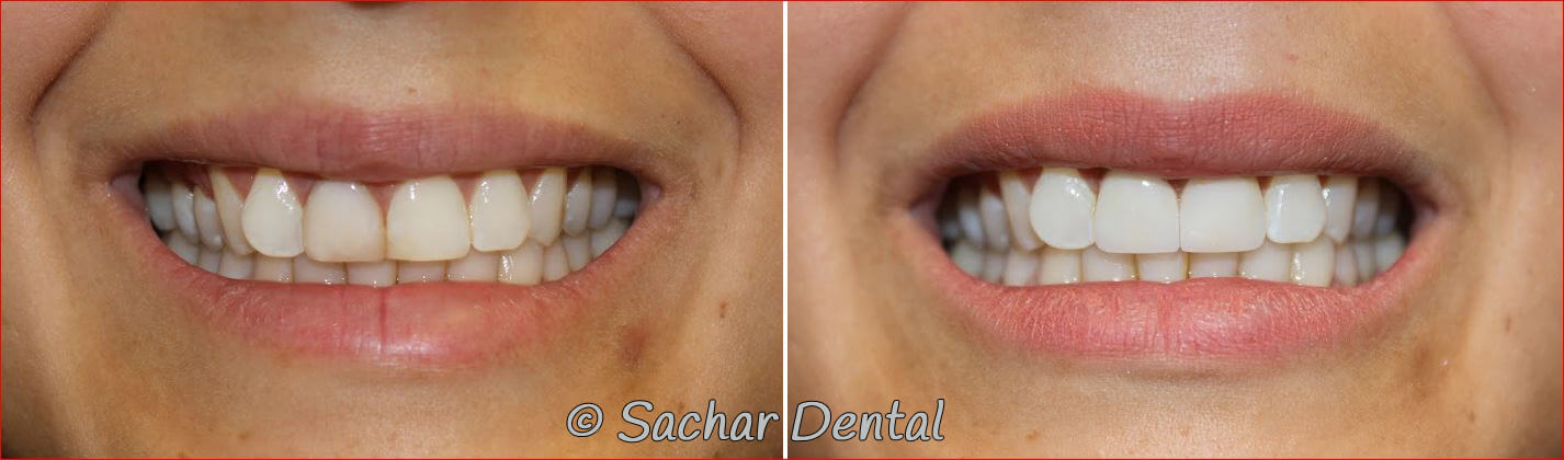 NYC cosmetic dentistry. Before and after pictures of porcelain crowns