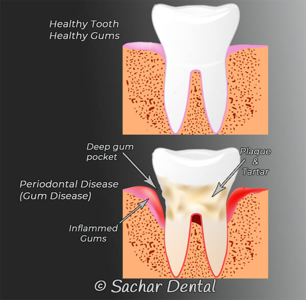 Teeth cleaning vs Deep cleaning