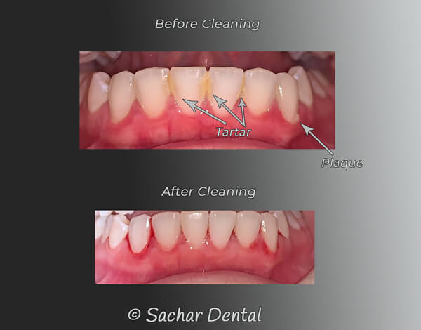 Dentist NYC for teeth cleanings in Manhattan