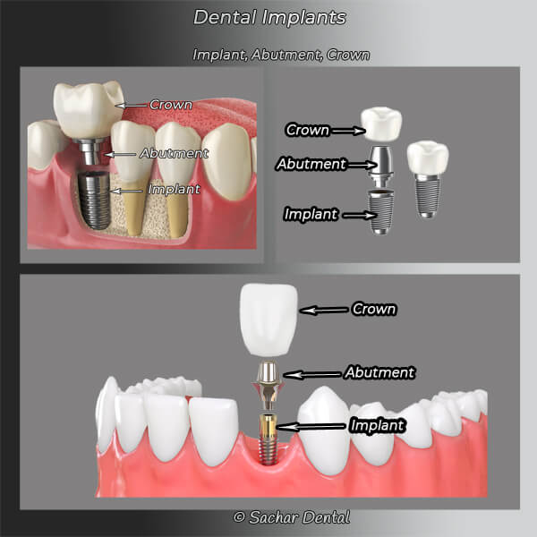 Picture of 3 diagrams showing dental implants abutments and crowns