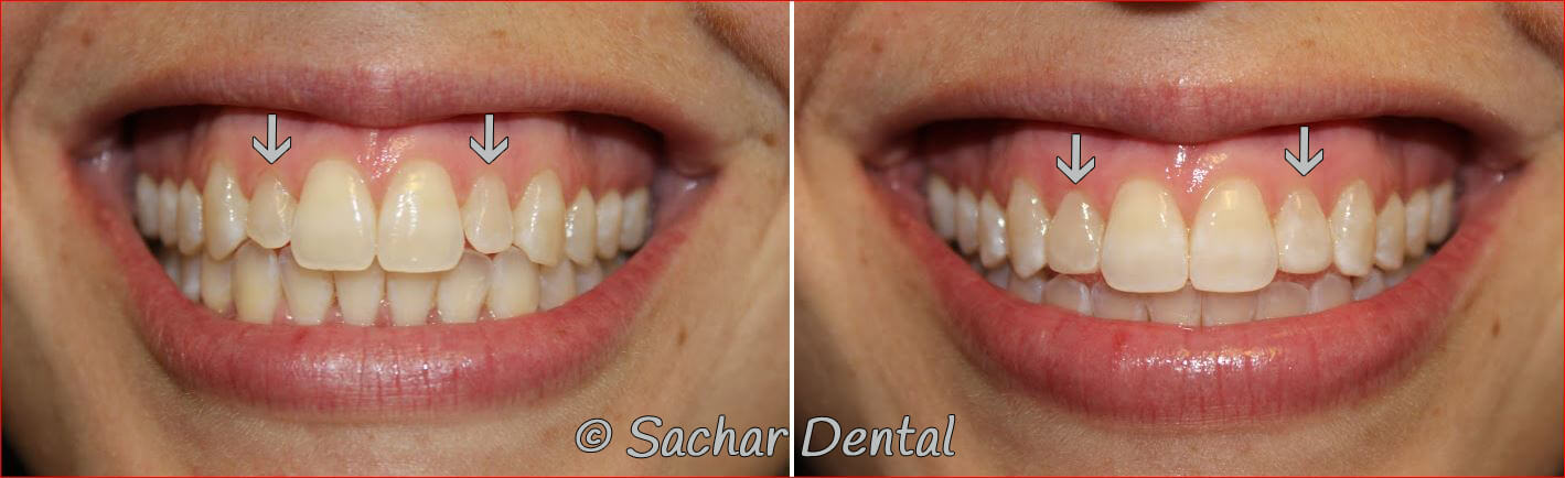 Top NYC cosnetic dentist for resin veneers. Before and after pictures of resin bondings