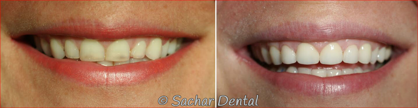 NYC cosmetic dentist at Sachar Dental. Before and after pictures of porcelain veneers