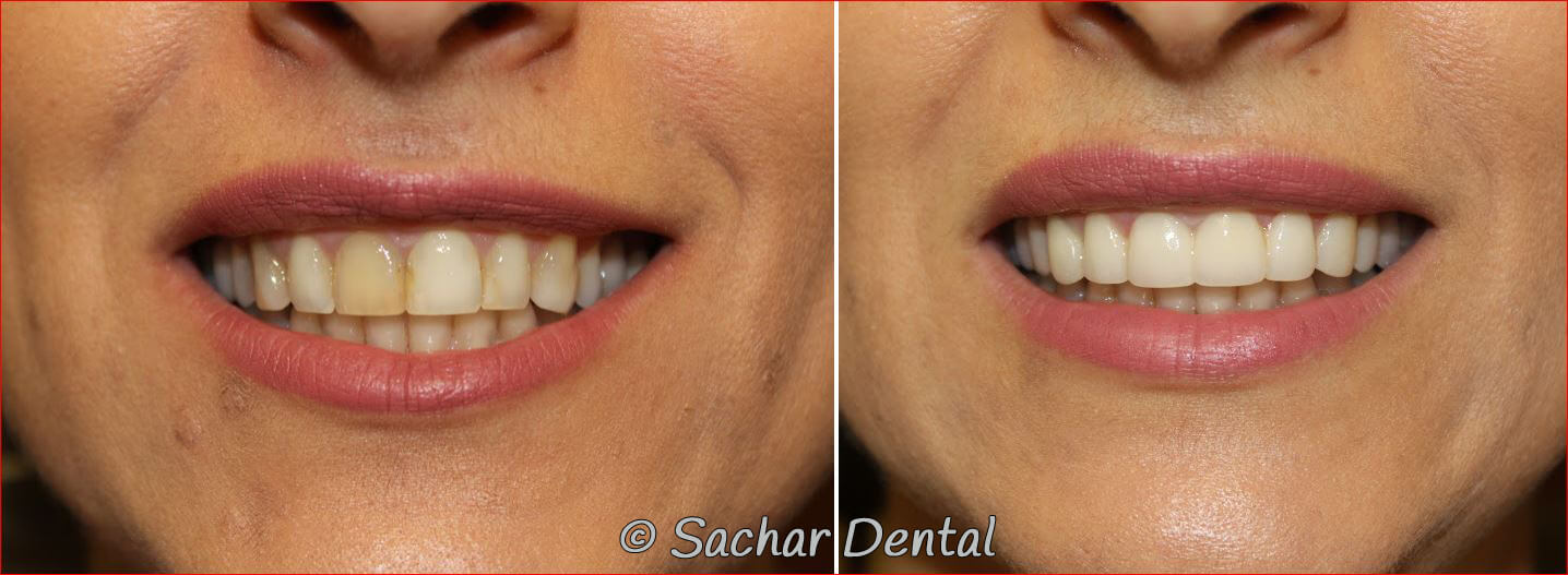 Top Cosmetic Dentist in New York City for Porcelain Veneers