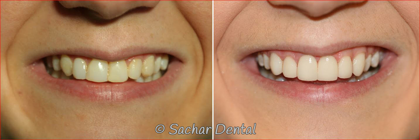 Before and after pictures of porcelain veneers