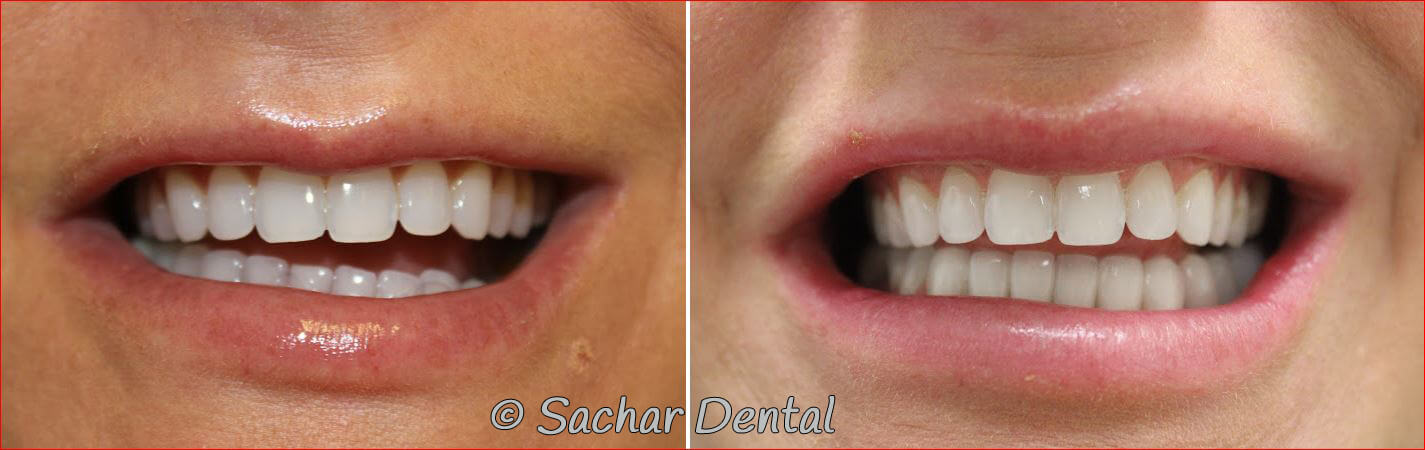Before and after pictures of porcelain veneers and a 3 tooth bridge