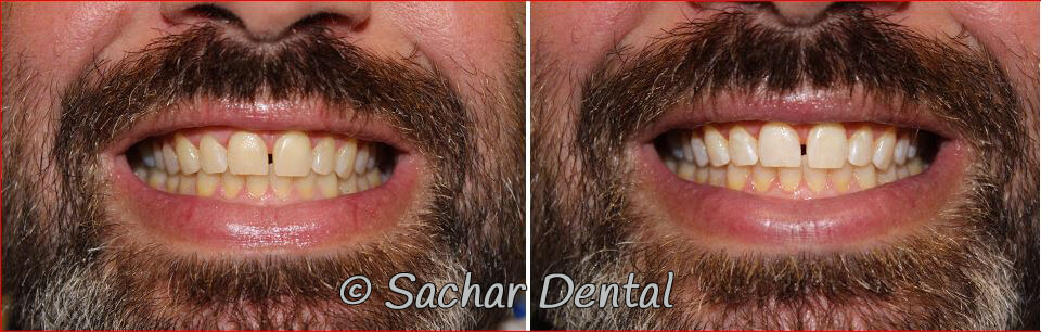 Best NYC cosmetic dentist for teeth whitening. Before and after pictures of in office teeth whitening