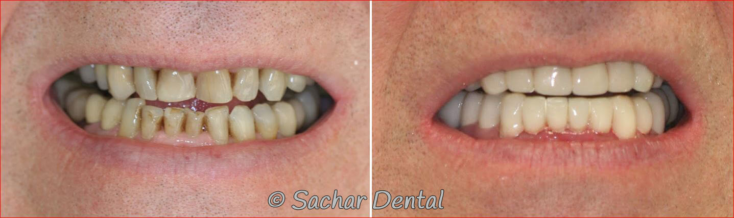 Before and after pictures of full mouth reconstruction with porcelain crowns, porcelain veneers, dental implants