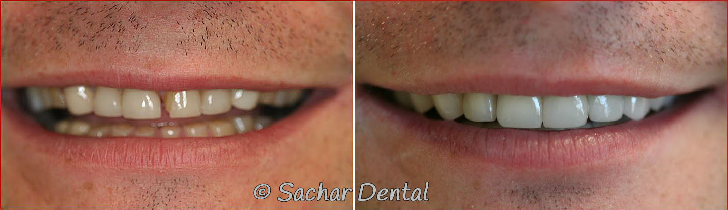 Best Cosmetic Dentist in NYC for full mouth reconstruction