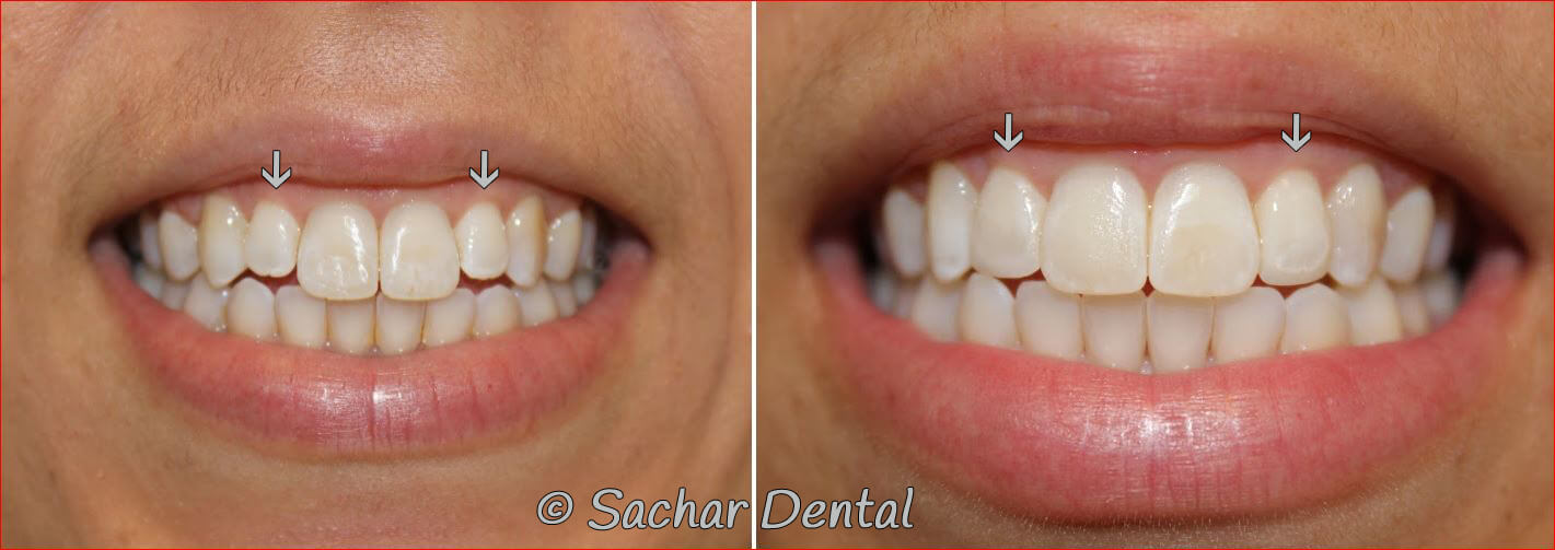 Before and after pictures of resin bonding veneers