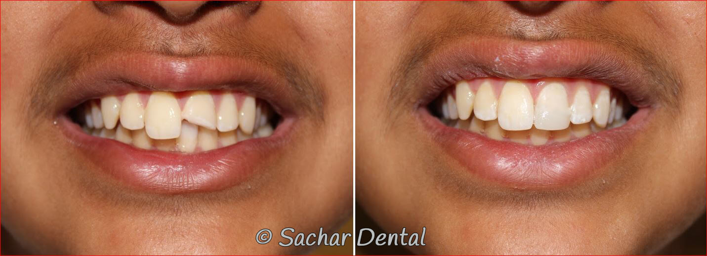 Cosmetic Dentist NYC, Before and after pictures for resin bondings.