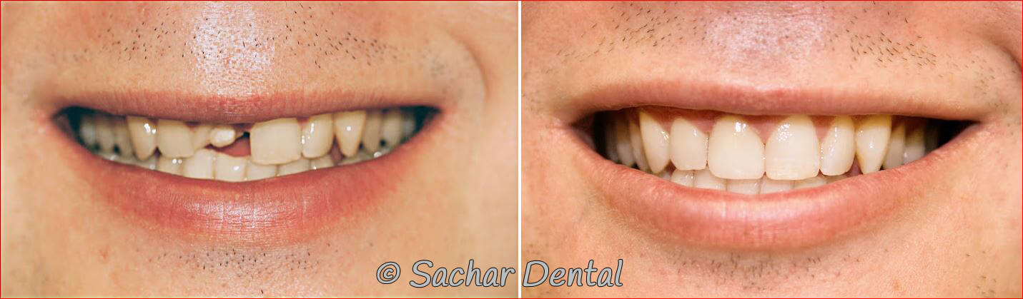 Before and after pictures Cosmetic Dentistry NYC