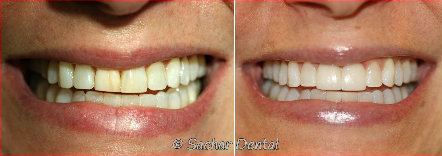 Best NYC Cosmetic Dentist for porcelain Crowns and veneers