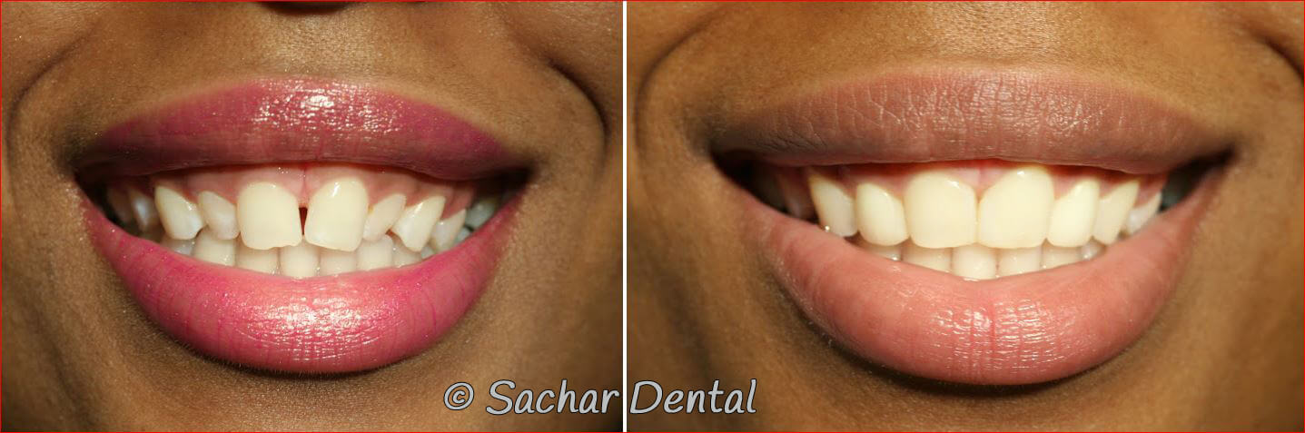 Top NYC cosmetic dentist for resin bondings. Here are before and after pictures of resin bondings