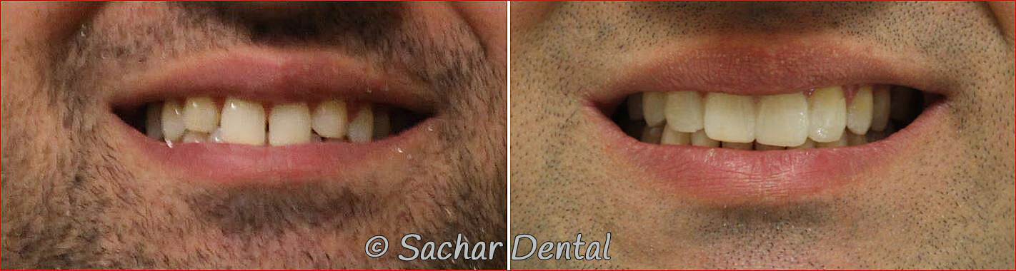 Before and after pictures of resin veneers bondings