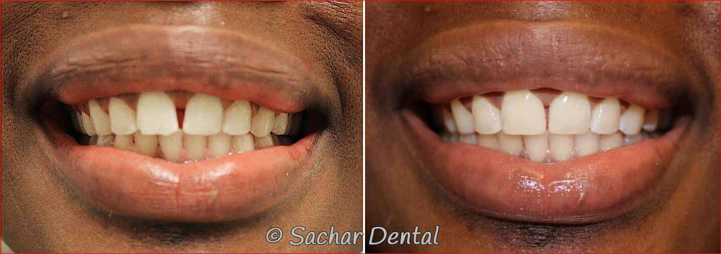 before and after pictures and resin bonding veneers