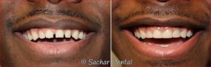 Manhattan Cosmetic Dentist for tooth colored fillings