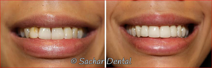 Before and after pictures of NYC Cosmetic Dentistry NYC