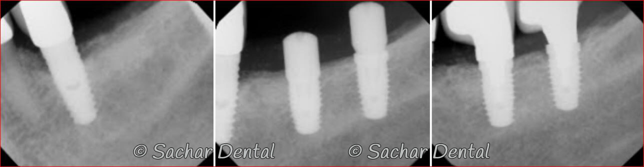 Picture of Before and after x-rays of dental implants