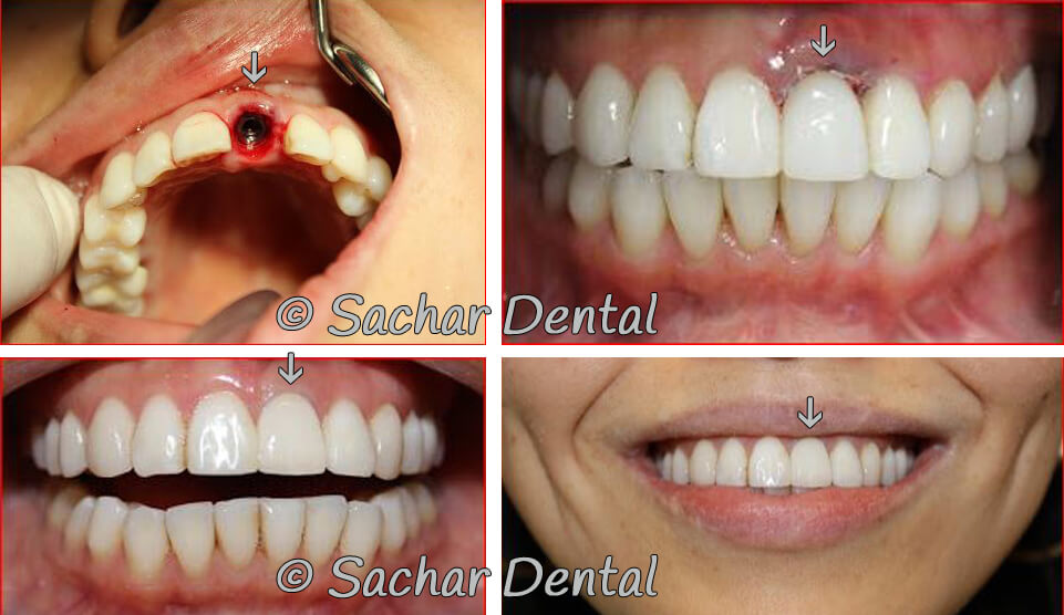 Dental Implants at Sachar Dental NYC