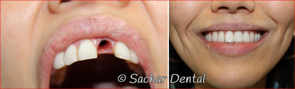 Before and after pictures of dental implants