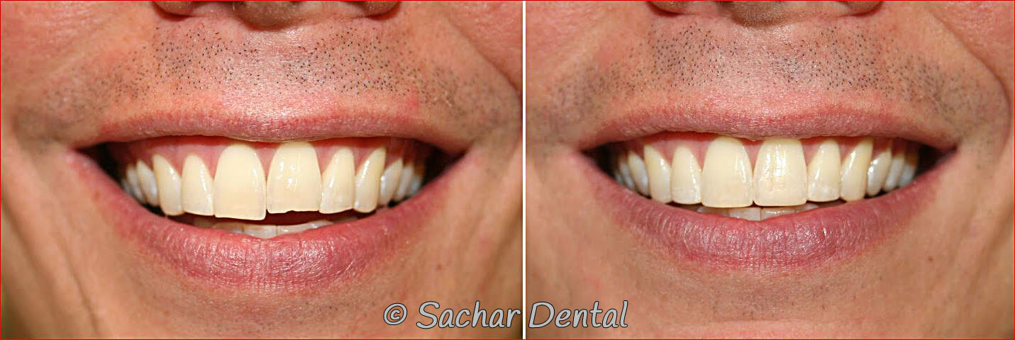 Before and after pictures of resin bonding of chipped teeth