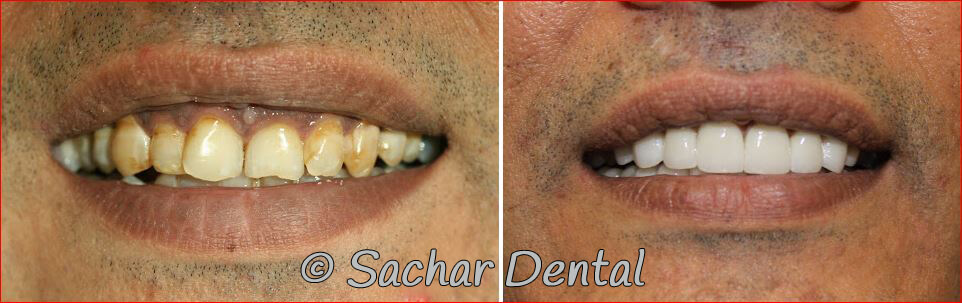 Cosmetic Dentistry NYC Before and after pictures of smile makeover with porcelain veneers