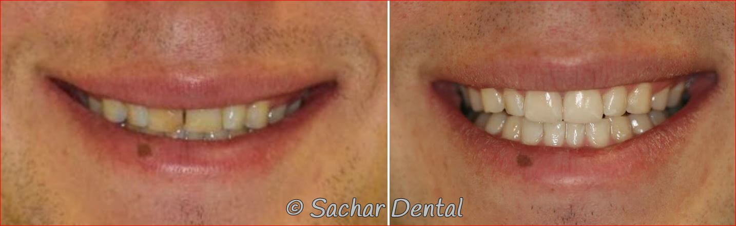 Before and after pictures of porcelain crown and porcelain veneer