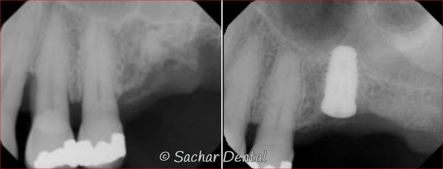 NYC Dental Implants / Sachar Dental NYC